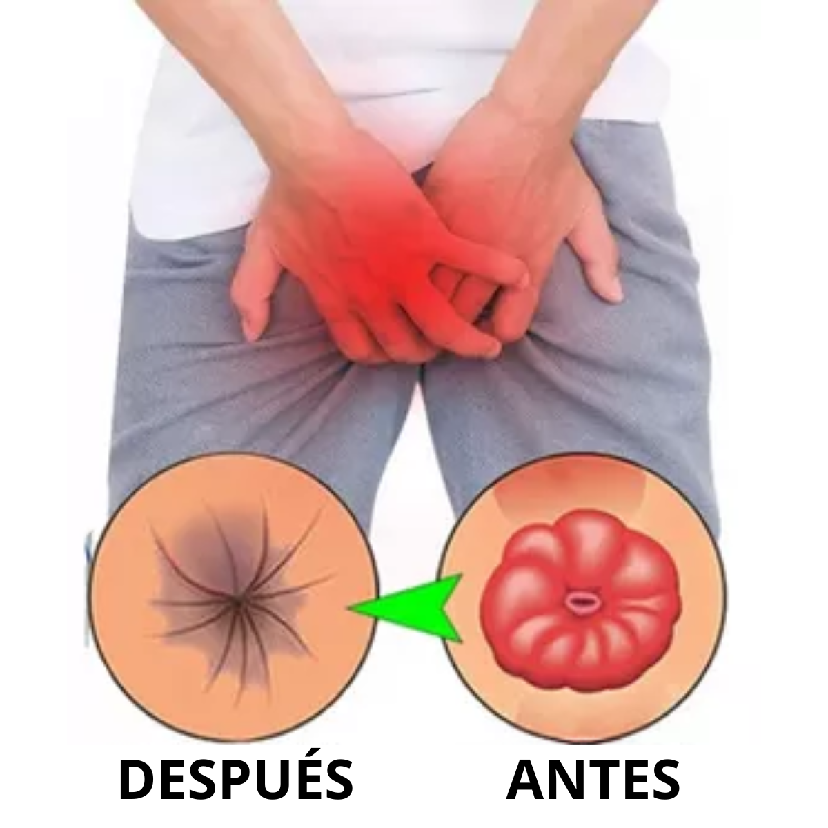 HERBAL para hemorroides (Gotero)