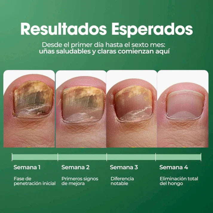 ¡TERBINAFINA!: El aceite que elimina los hongos de tus uñas - Neutraliza el mal olor y repara la piel. Fórmula vegana, segura y de uso diario