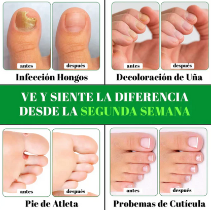 ¡TERBINAFINA!: El aceite que elimina los hongos de tus uñas - Neutraliza el mal olor y repara la piel. Fórmula vegana, segura y de uso diario